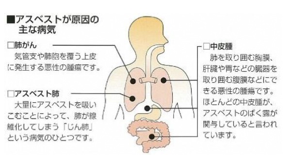 アスベストが原因の主な病気（肺がん・アスベスト肺・中皮腫）